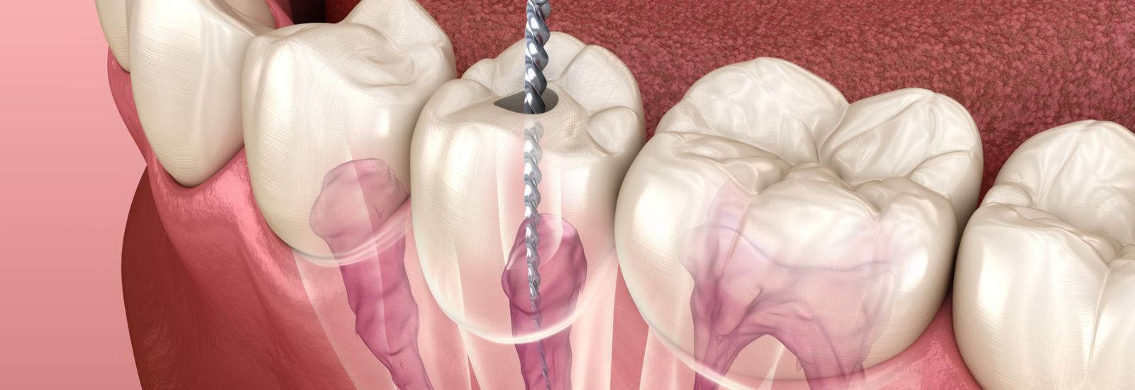 Root canals